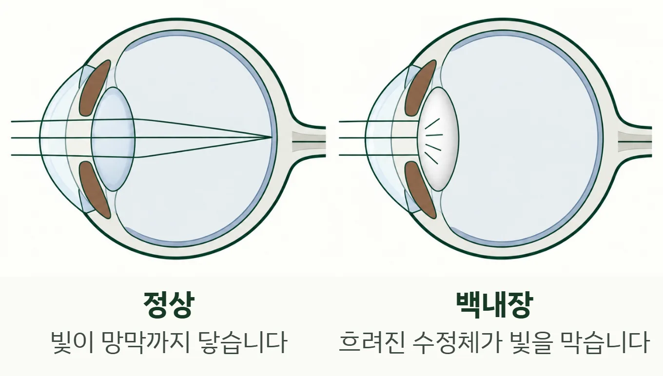 눈 단면 그림: 맑은 수정체는 빛을 망막까지 보내고, 흐려진 수정체는 빛을 막는다
