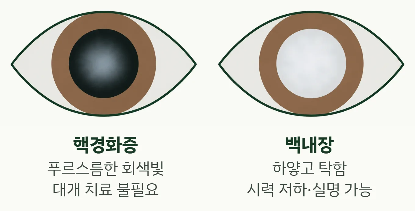 핵경화증(푸르스름한 회색빛)과 백내장(하얗고 탁함) 비교 그림