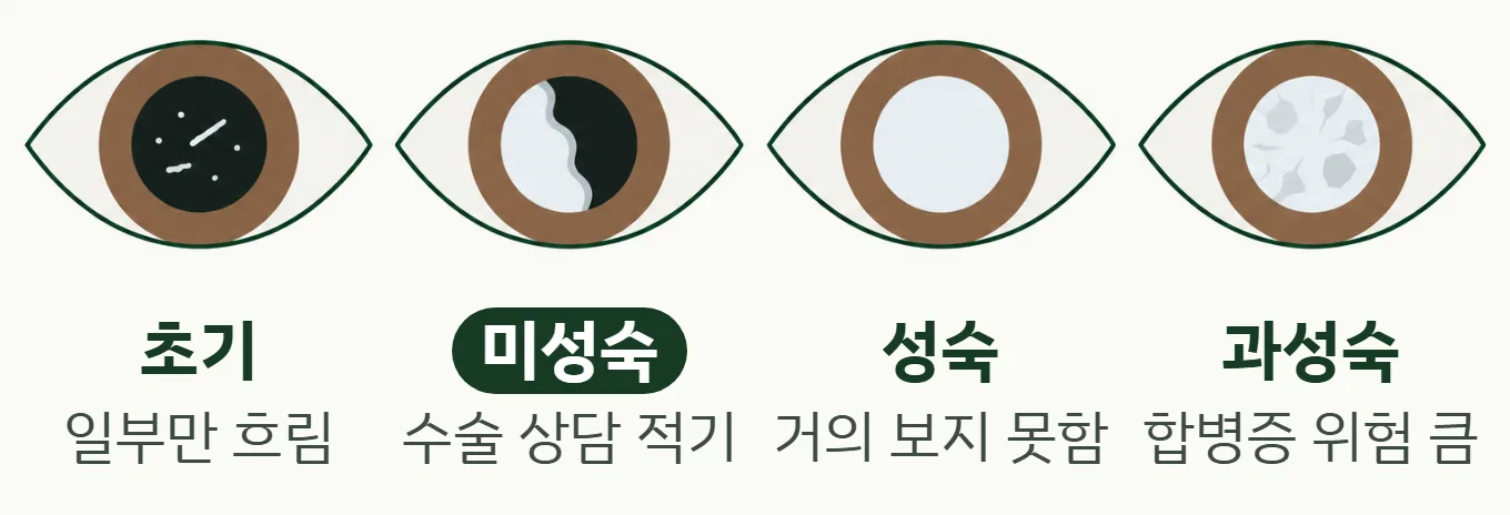 백내장 진행 4단계 그림: 초기, 미성숙, 성숙, 과성숙